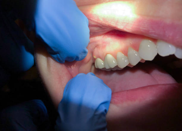 Best Dental Abscess Treatment in Richmond, IN
